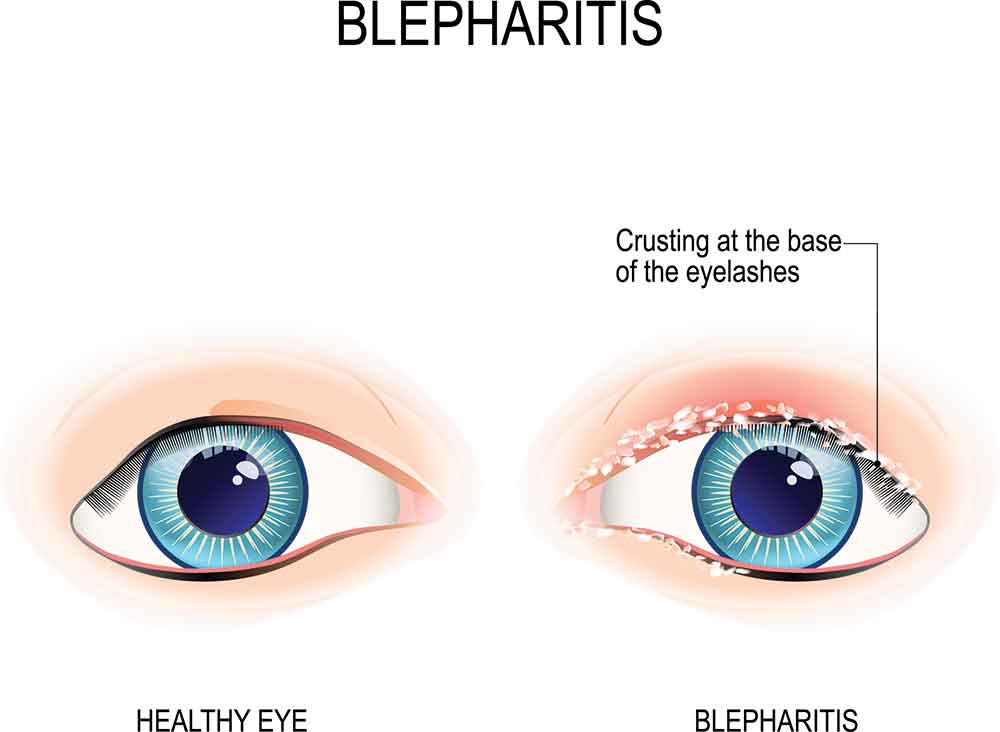 blepharitis-eye-physicians-surgeons-in-adelaide